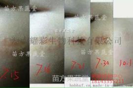 苗方果蔬堂烧烫伤疤痕修复 妊娠纹修复 祛疤痕