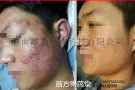 长沙祛痘医美机构 祛痘不复发 无刺激